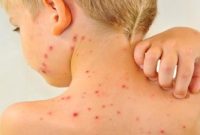 افزایش موارد ابتلا به سرخک در اهواز