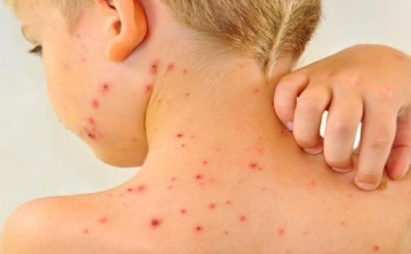 افزایش موارد ابتلا به سرخک در اهواز افزایش موارد ابتلا به سرخک در اهواز